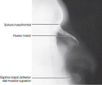 Nasal bones anatomy